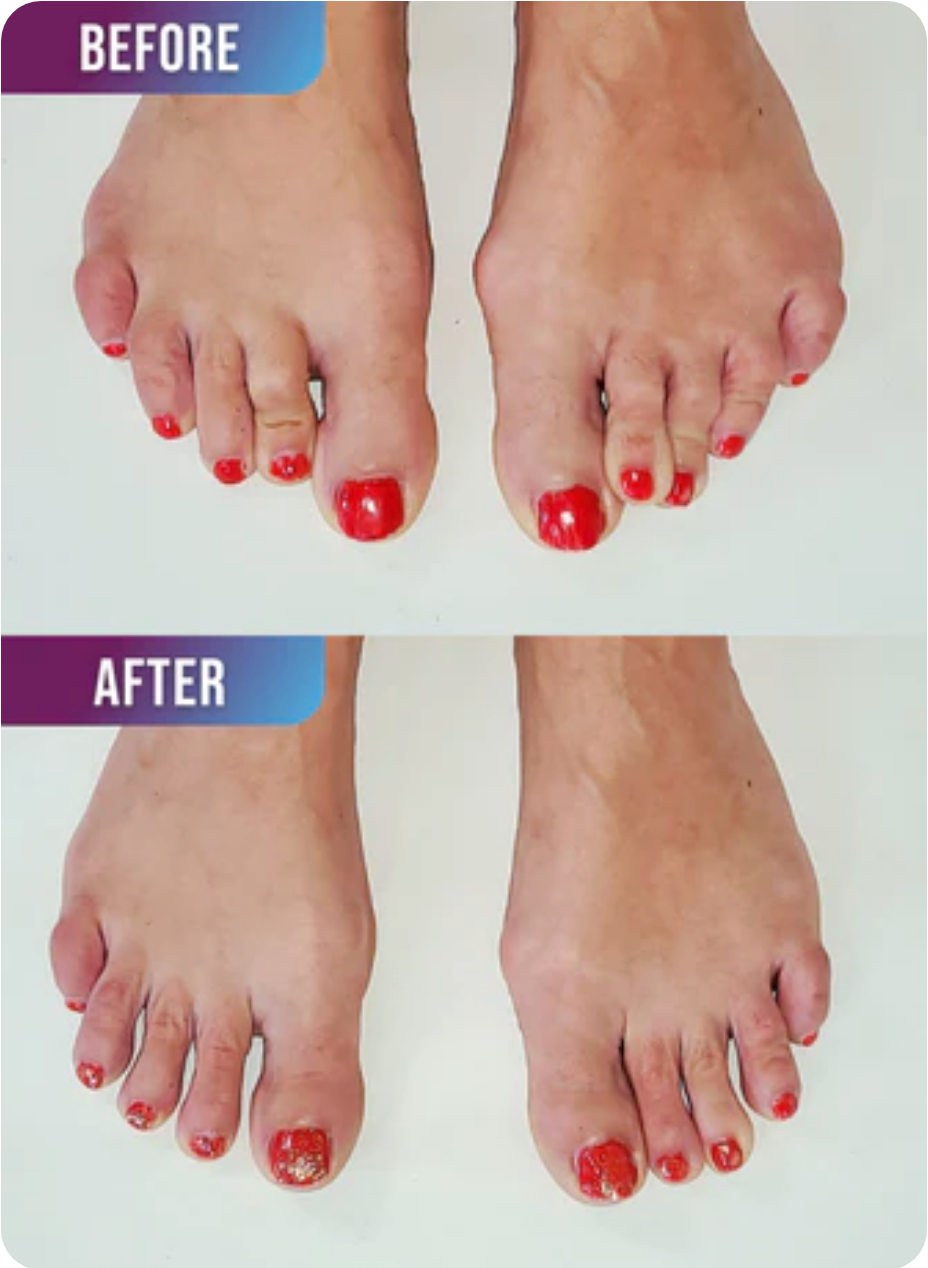 Toe Spreaders